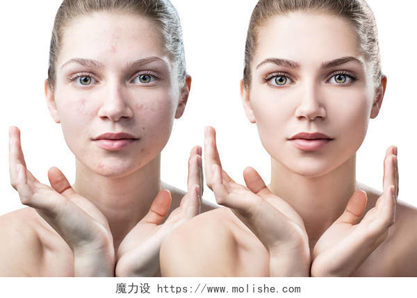 妇女痤疮之前和之后的治疗和化妆美容皮肤